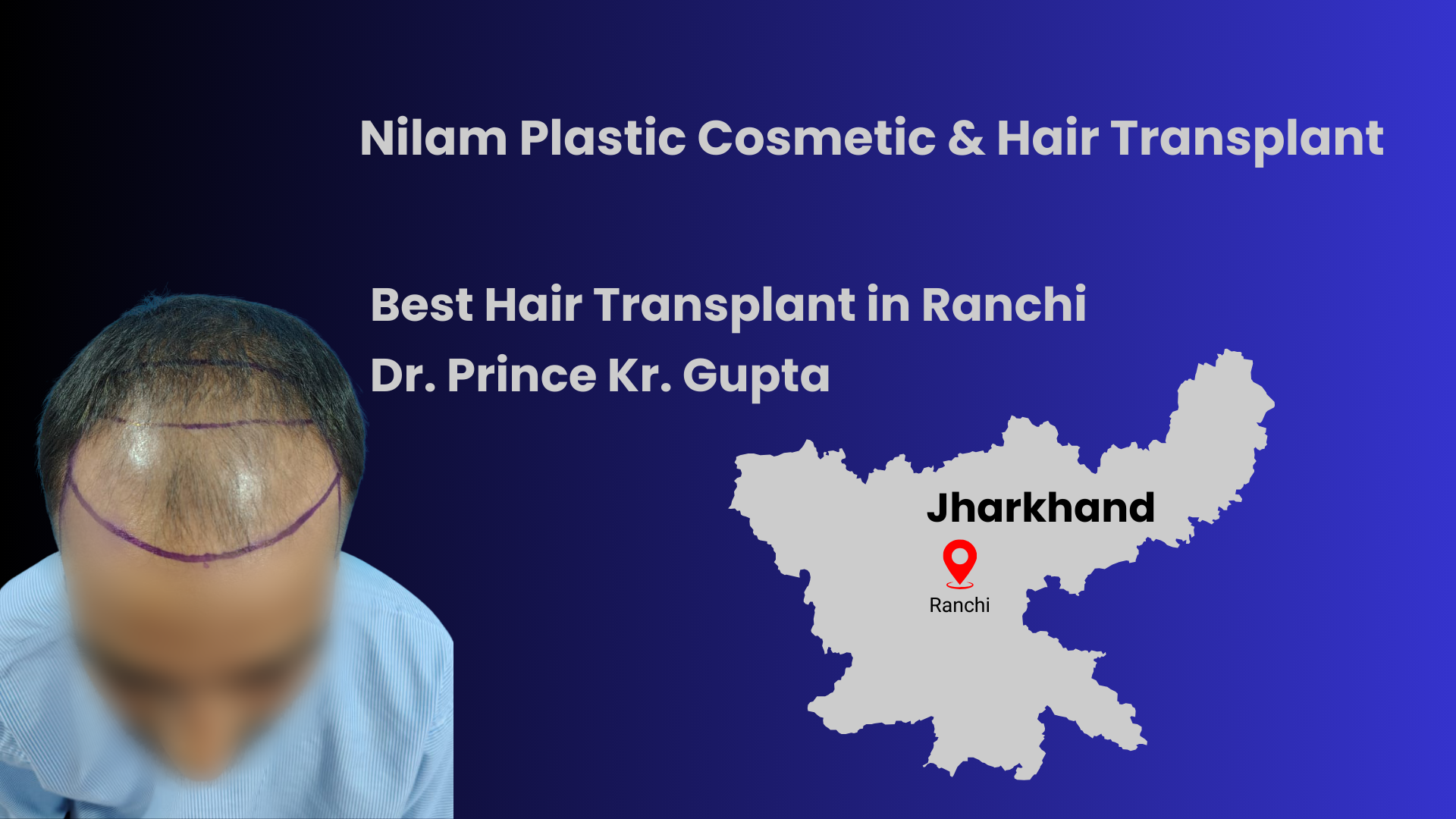 Hair Transplant in Ranchi: Your Complete Guide to Permanent Hair Restoration