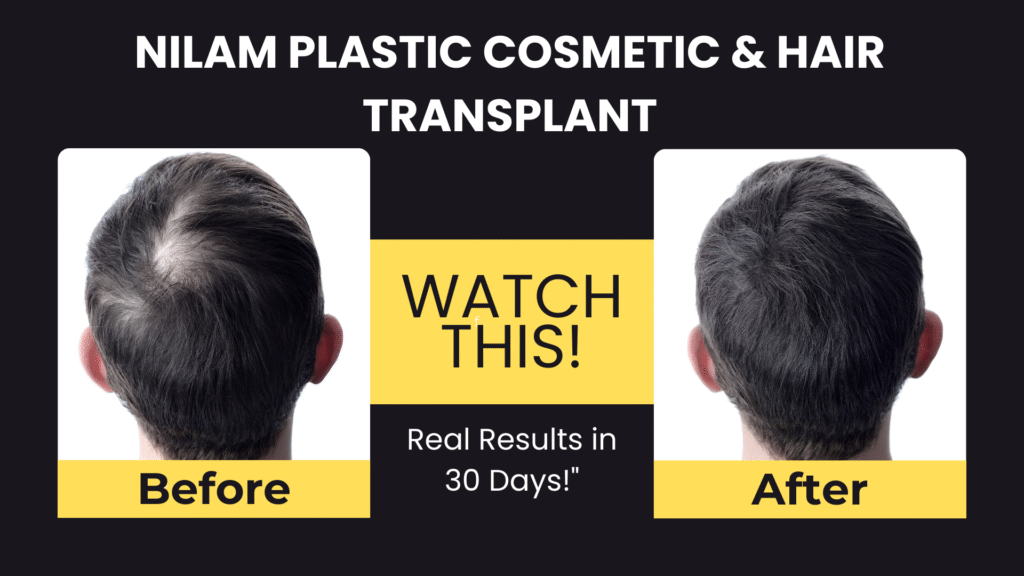 Hair Transplant in Ranchi