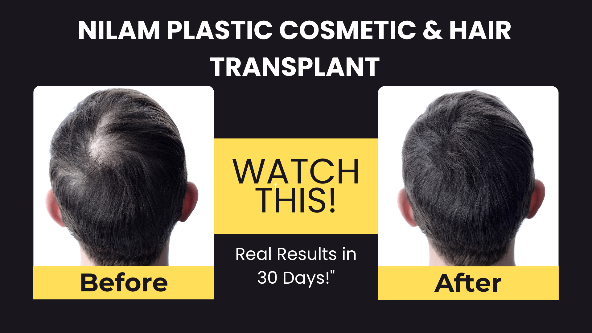 Hair Transplant in Ranchi | Best Clinic & Cost 2026