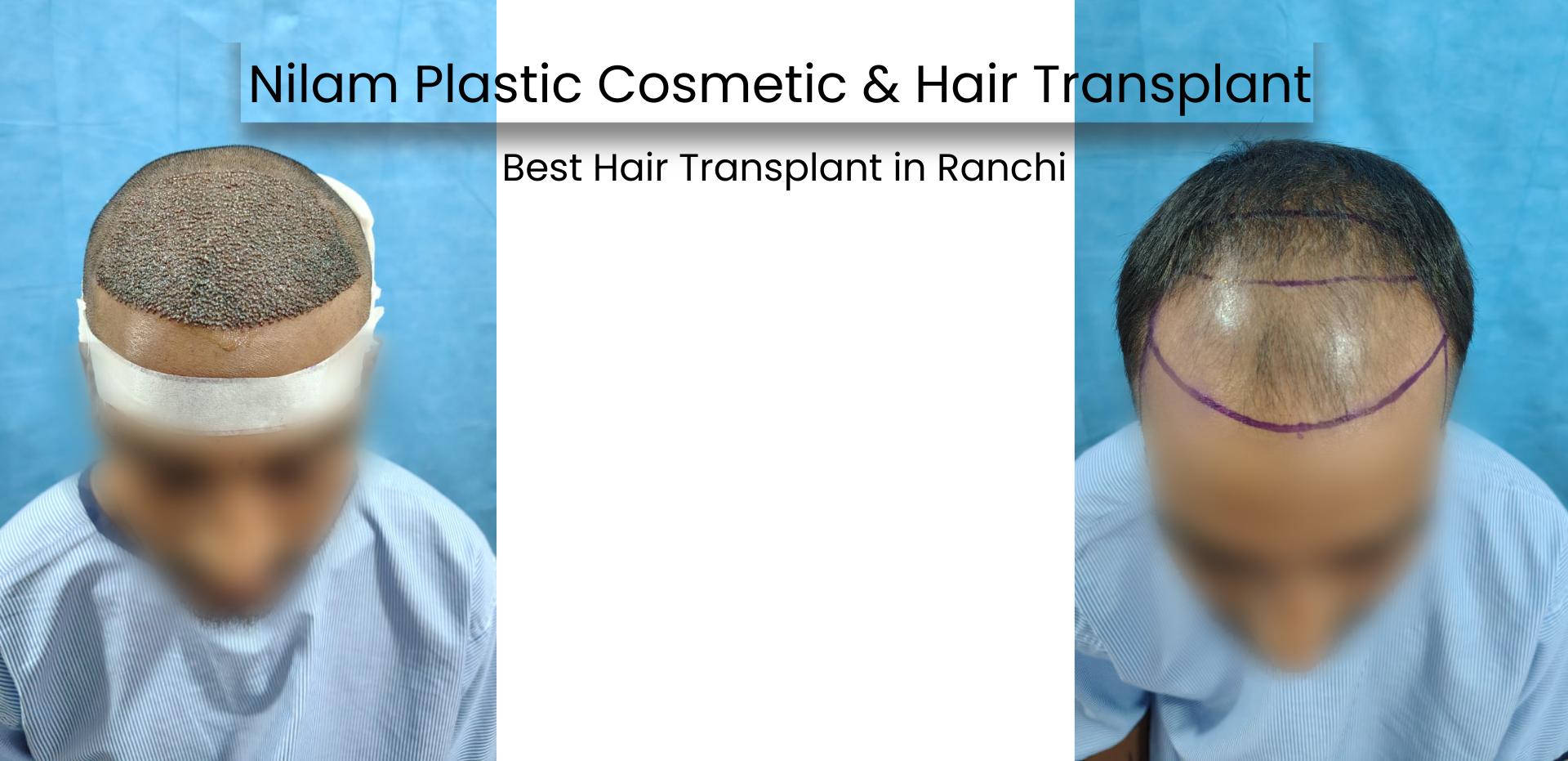 Finding the Right Hair Transplant Doctor: Why Dr. Princ kr. Gupta in Ranchi is Your Best Choice