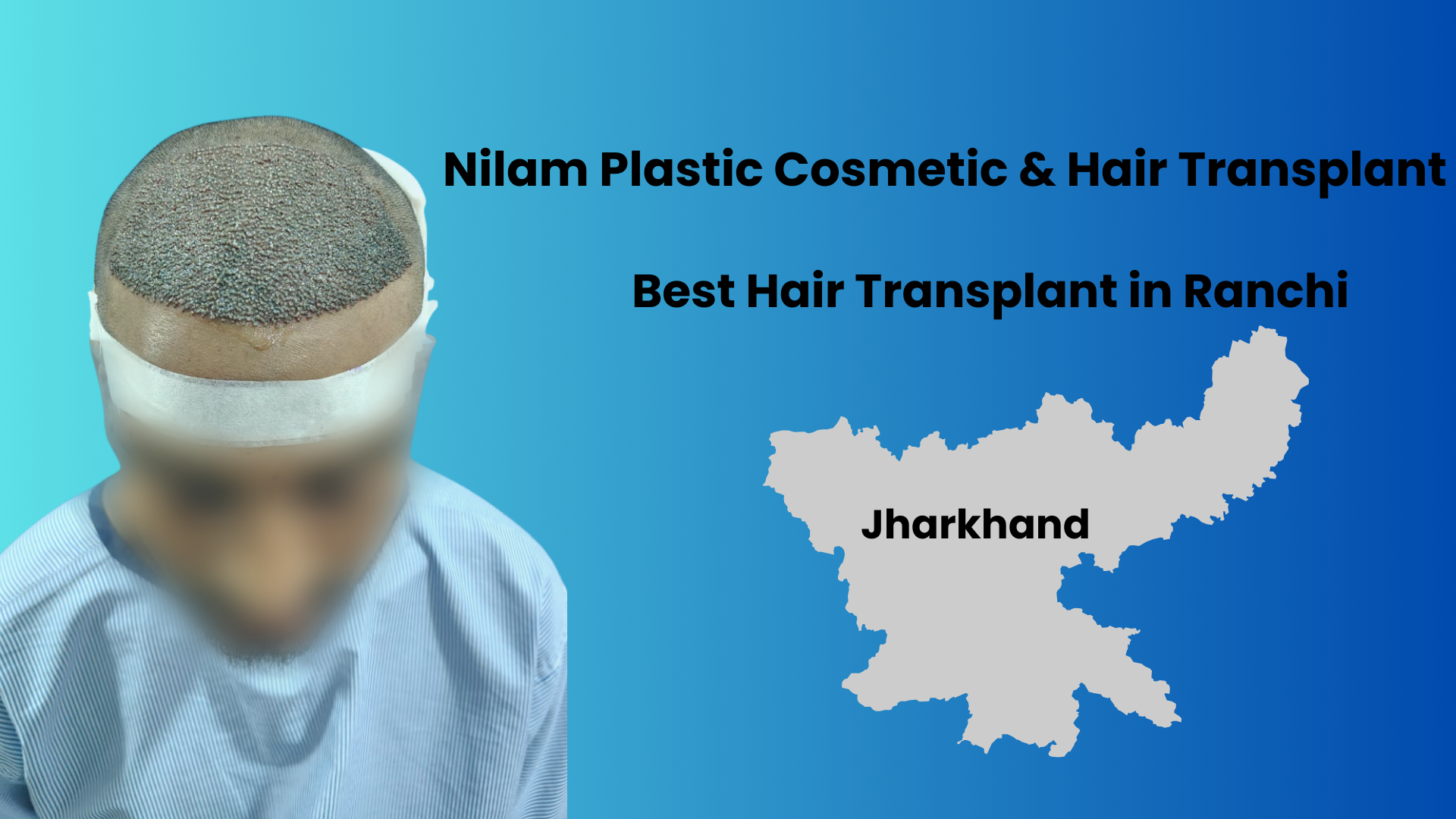 Complete Guide to Hair Transplant in Ranchi, Jharkhand: Cost, Techniques & Expert Care