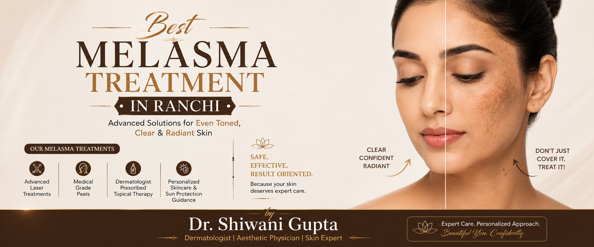 Best Melasma Treatment in Ranchi: Your Complete Guide by Dr. Shiwani Gupta